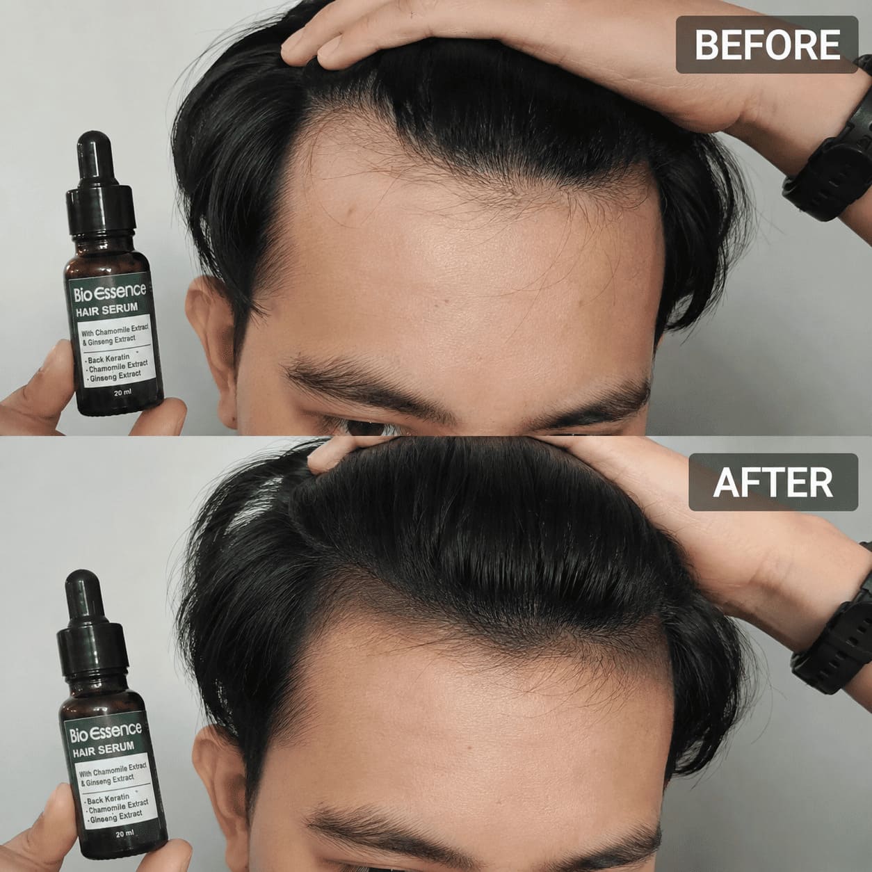 Before After M-Shape